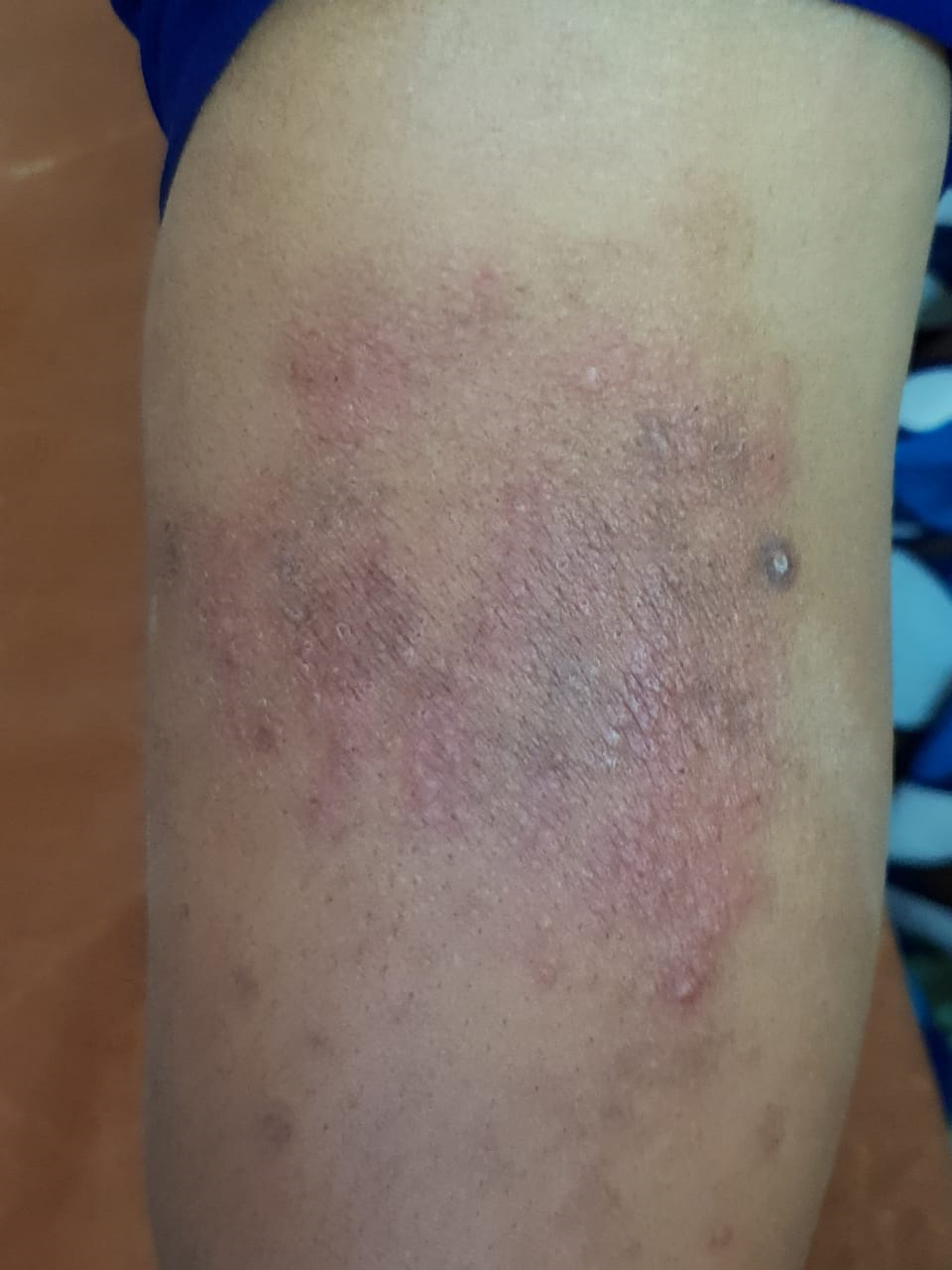 Dermatofibroma on leg in 37-year-old Black woman, demonstrating lack of