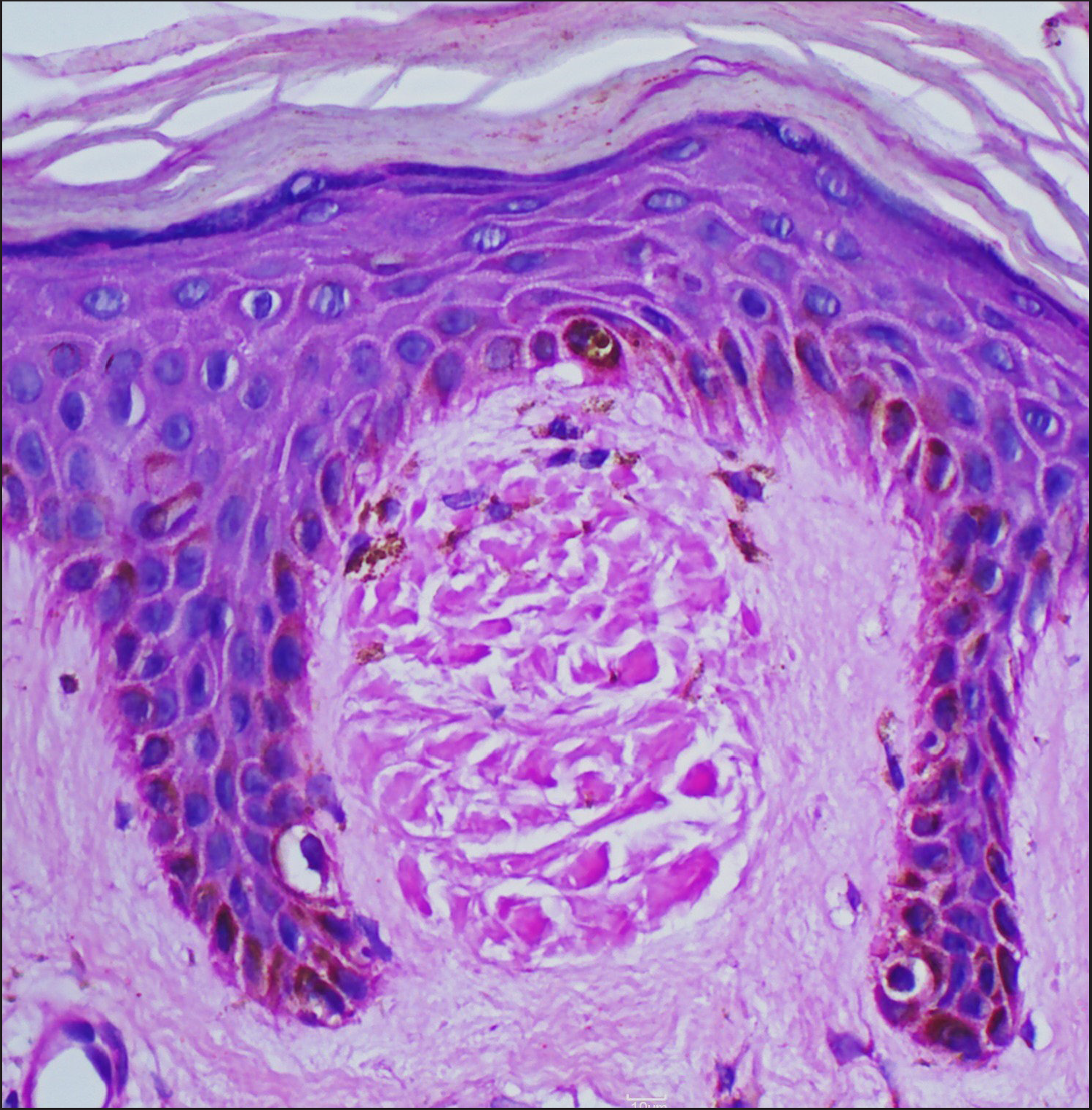 Primary cutaneous amyloidosis showing deposition of amorphous, eosinophilic material in widened papillary dermis (H and E, 400x)