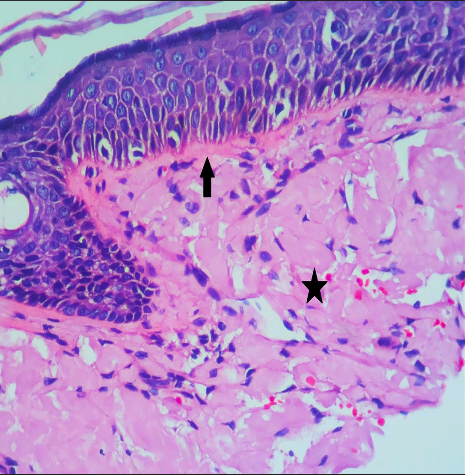 Colloid degeneration in colloid milium showing deposition of amorphous eosinophilic material in upper dermis (asterisk) separated from epidermis by normal connective tissue (arrow) (H and E, 400x)