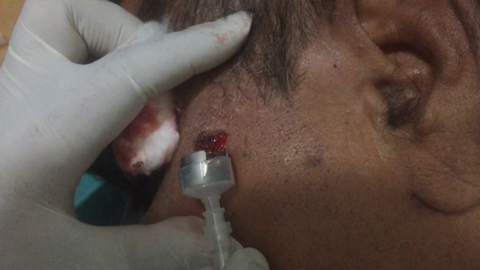 A seborrheic keratosis is shaved with a customised blade with a syringe barrel holder