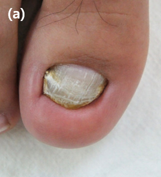 Transverse rim at the distal edge of the right great toenail with nail shortening, thickening and discolouration