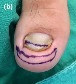 Prior to surgical intervention, an incision line was drawn with a 7 mm-width crescent shape parallel to the distal and lateral nail folds around the toe tip, and a mark is left on the distal third of the toenail