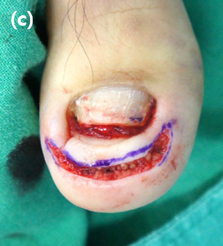 Sufficient soft tissue is removed in a wedge shape, the distal third of the toenail is removed with curettage of the nail bed