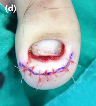Pulling down of the thickened distal pulp by the sutures