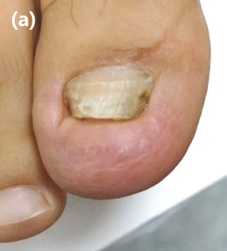 2 weeks postoperatively, the distal pulp is slightly swollen, but the toenail has grown