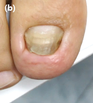 4 months postoperatively, the toenail has grown consistently, but with mild obstruction due to the slightly thickened distal pulp