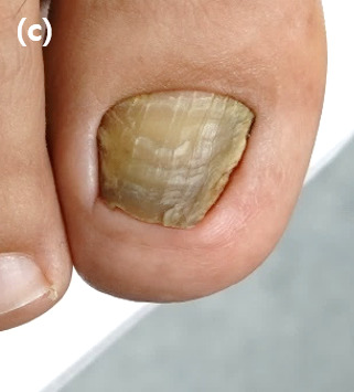 12 months postoperatively, the toenail is seen to grow further, however, transverse lines appear, and a yellow-brown nail colour change is observed