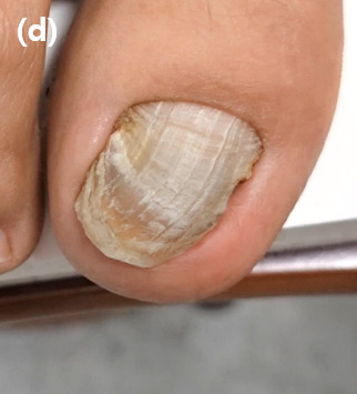 28 months postoperatively, the toenail has grown well over the distal pulp and shows mild lateral deviation