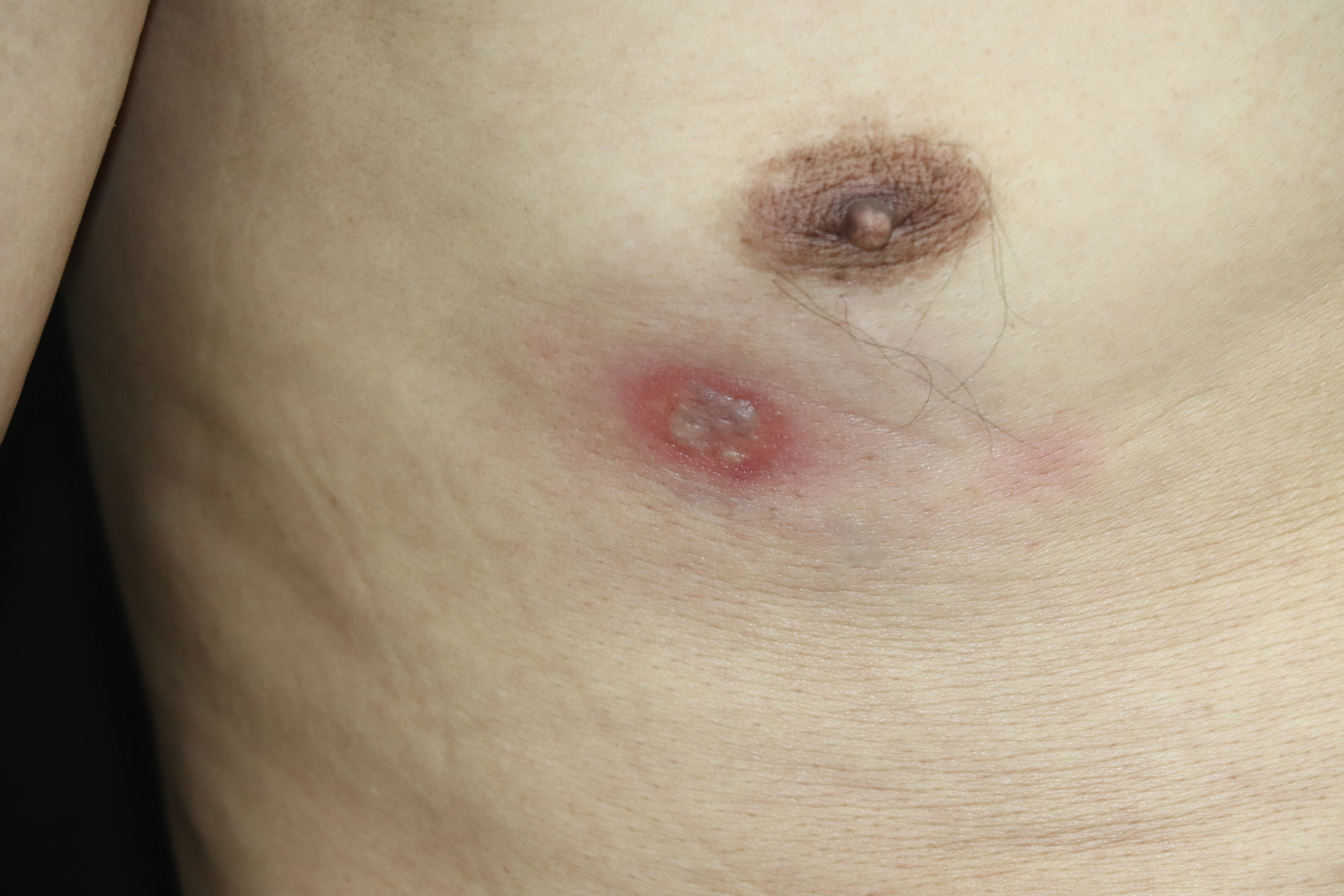 During hospitalisation, there was nodular erythema under the right breast with densely distributed pustules on the surface