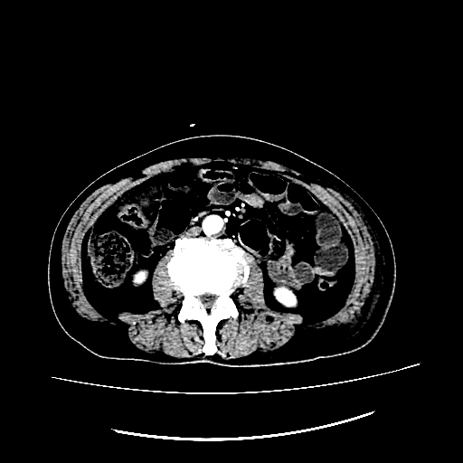 The local transverse colon was thickened, rough, and significantly enhanced. There were some gas shadows in the abdominal cavity