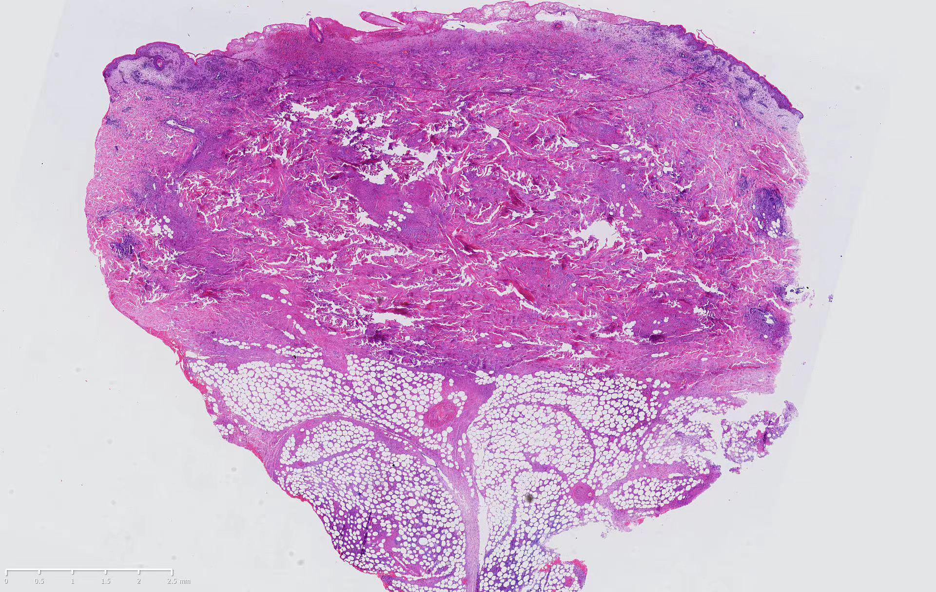 Histopathology of the left lower abdominal lesion (H and E, ×10) Epidermal necrosis and ulcer formation, epidermal cell edema, a large number of lymphoid cells infiltrating around blood vessels in the superficial dermis, necrosis of collagen fibers in the dermis, and mixed infiltration of lymphoid cells and inflammatory cells into fat lobules.