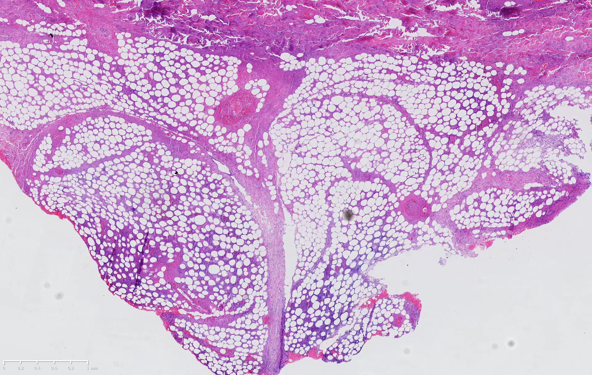 Biopsy of the left lower abdominal lesion, showing atypical lymphoid cells infiltration of fat lobules mixed with inflammatory cells (H and E, ×20)