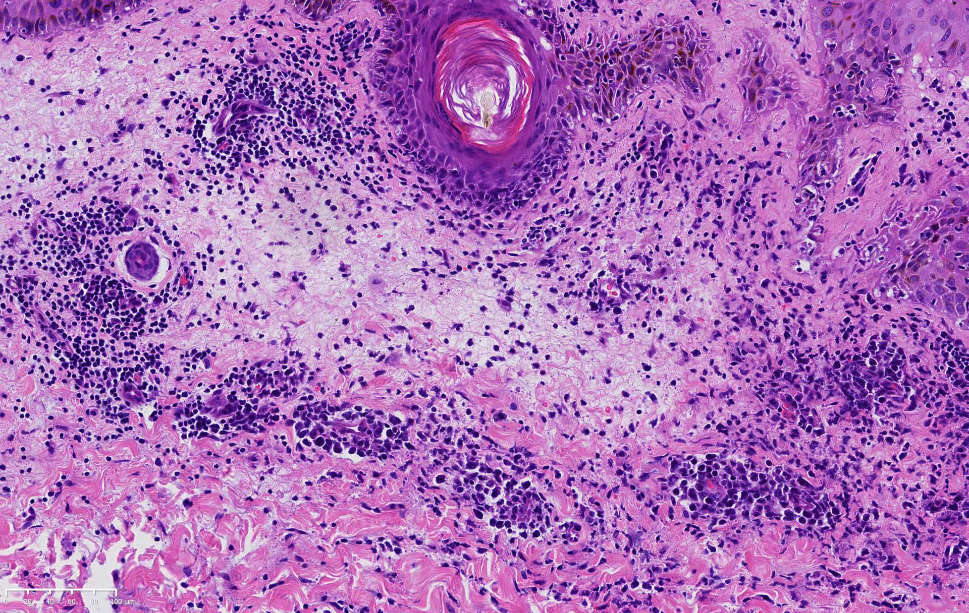 Biopsy of the left lower abdominal lesion, showing atypical lymphoid cells distributed throughout the dermis infiltrated the vascular wall or around the blood vessels (H and E, ×200)