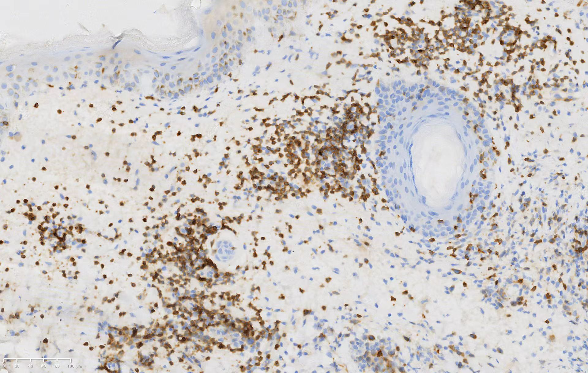 Atypical lymphoid cells positive for clusters of differentiation 3 in the biopsy (clusters of differentiation 3, ×200)