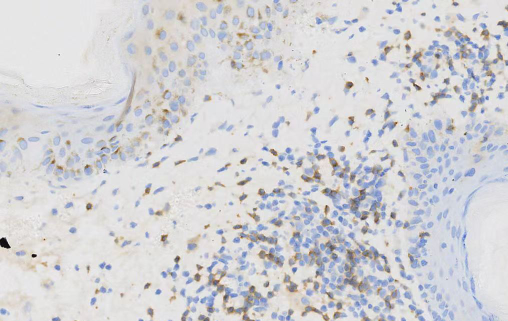 Atypical lymphoid cells partially positive for clusters of differentiation 8 in the biopsy (clusters of differentiation 8, ×200)