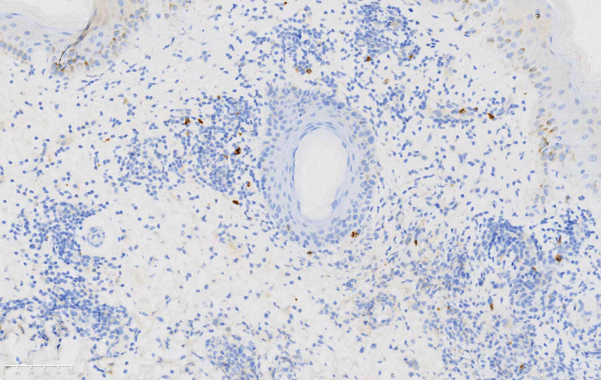 Atypical lymphoid cells negative for clusters of differentiation 20 in the biopsy (clusters of differentiation 20, ×200)