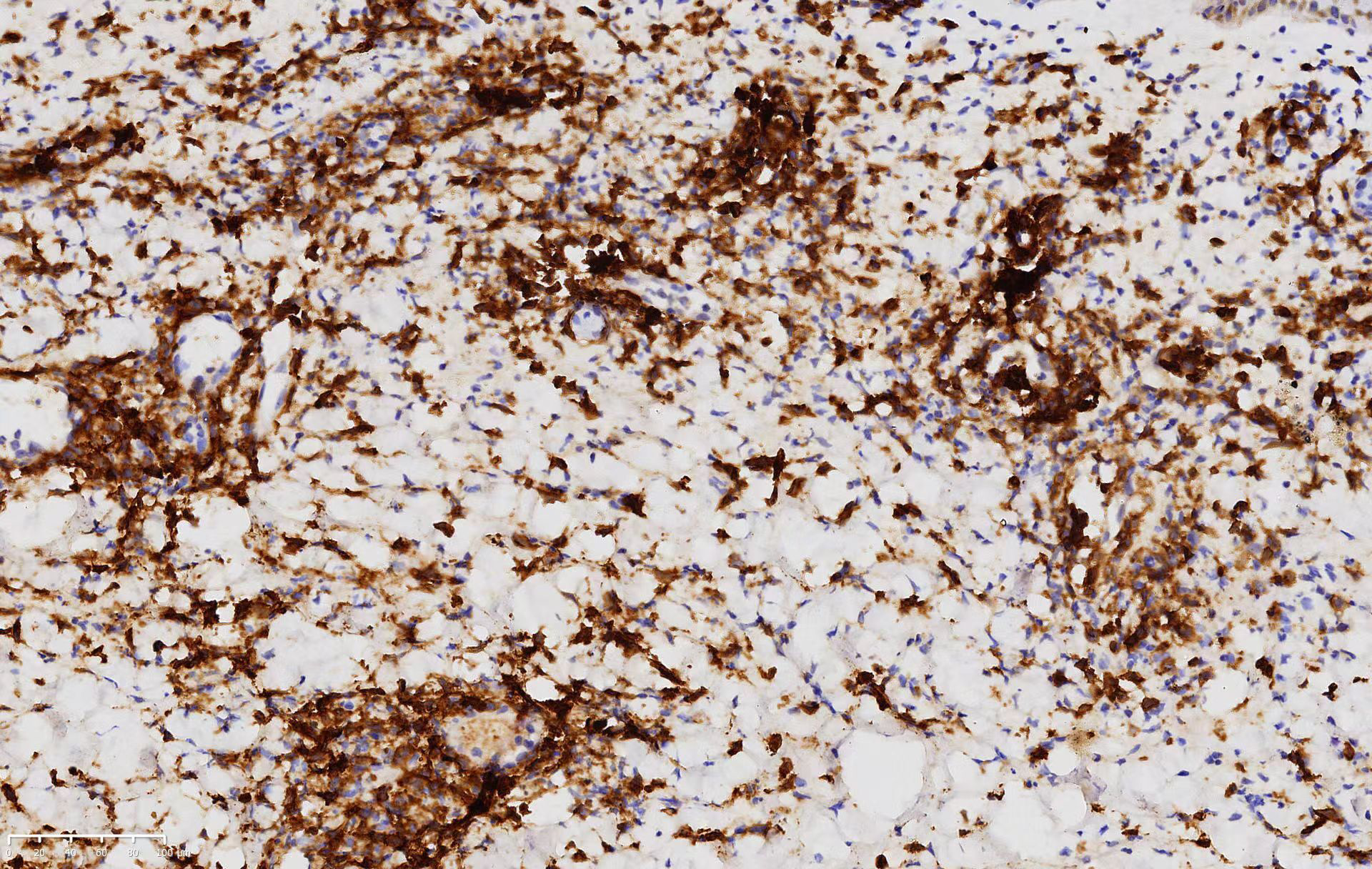 Atypical lymphoid cells positive for clusters of differentiation 56 in the biopsy (clusters of differentiation 56, ×200)