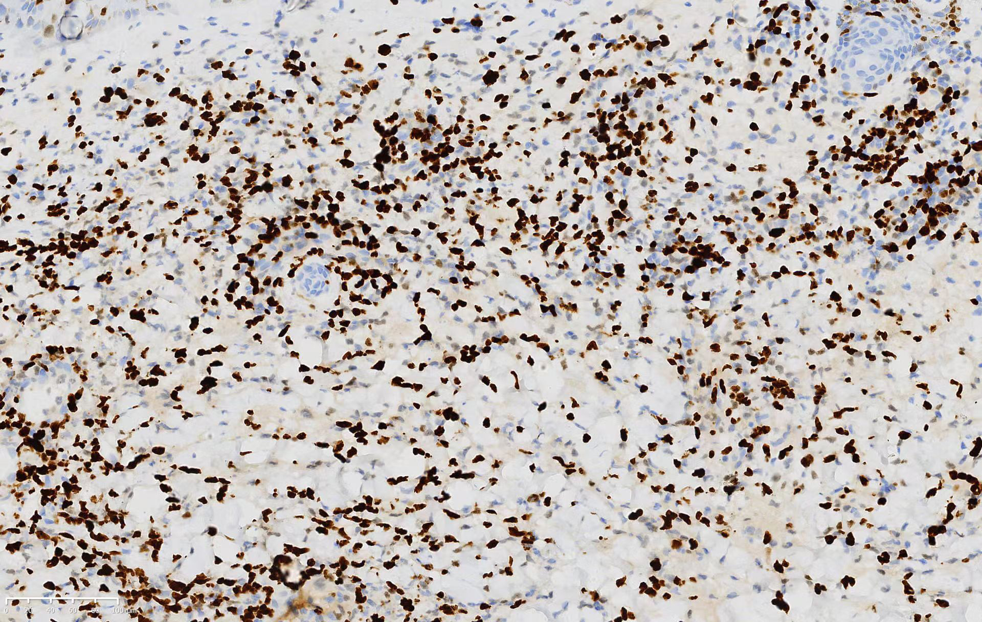 Atypical lymphoid cells partial positive for Ki-67 in the biopsy (Ki-67, ×200)