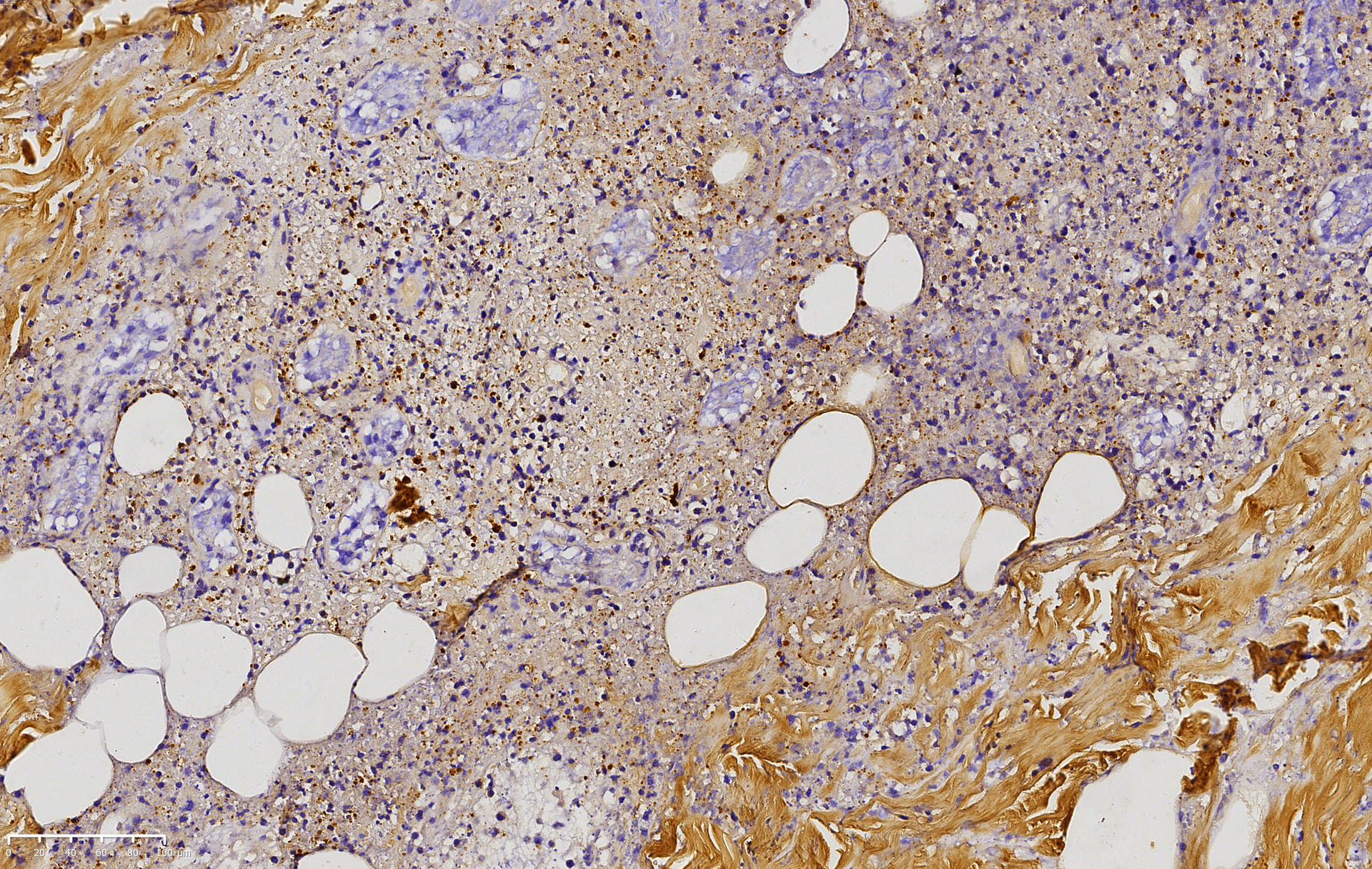 Atypical lymphoid cells positive for Epstein–Barr encoding region in the biopsy (Epstein–Barr encoding region, ×200)