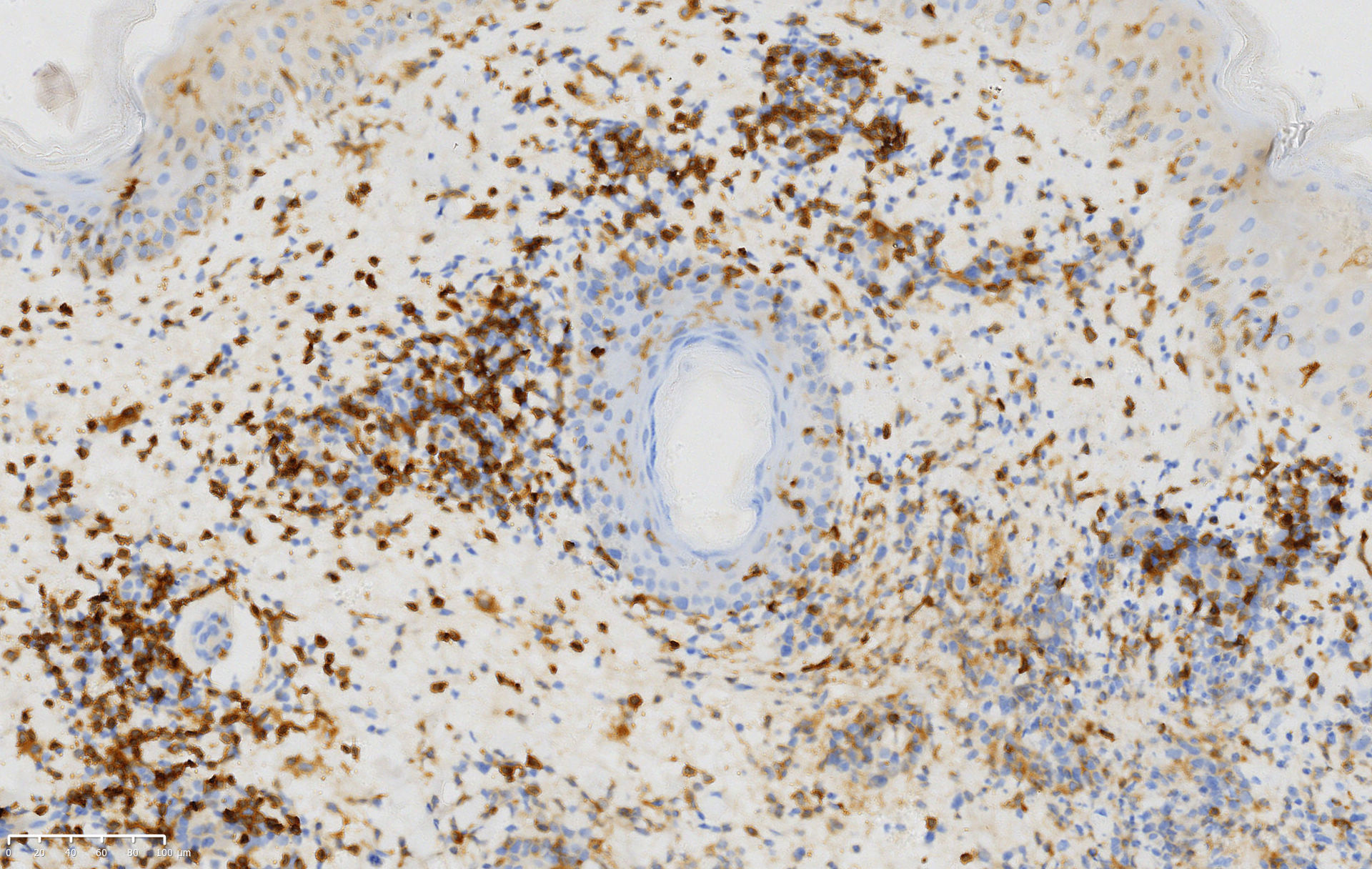 Atypical lymphoid cells positive for clusters of differentiation 4 in the biopsy (clusters of differentiation 4, ×200)