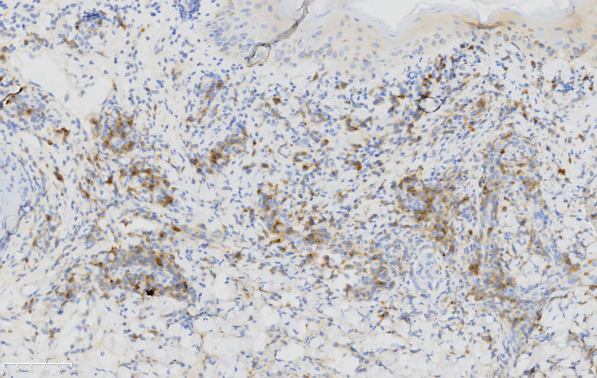 Atypical lymphoid cells positive for clusters of differentiation 30 in the biopsy (clusters of differentiation 30, ×200)