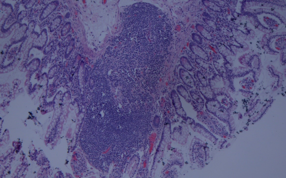 Biopsy scan of the small intestine tissue (H and E, × 40)