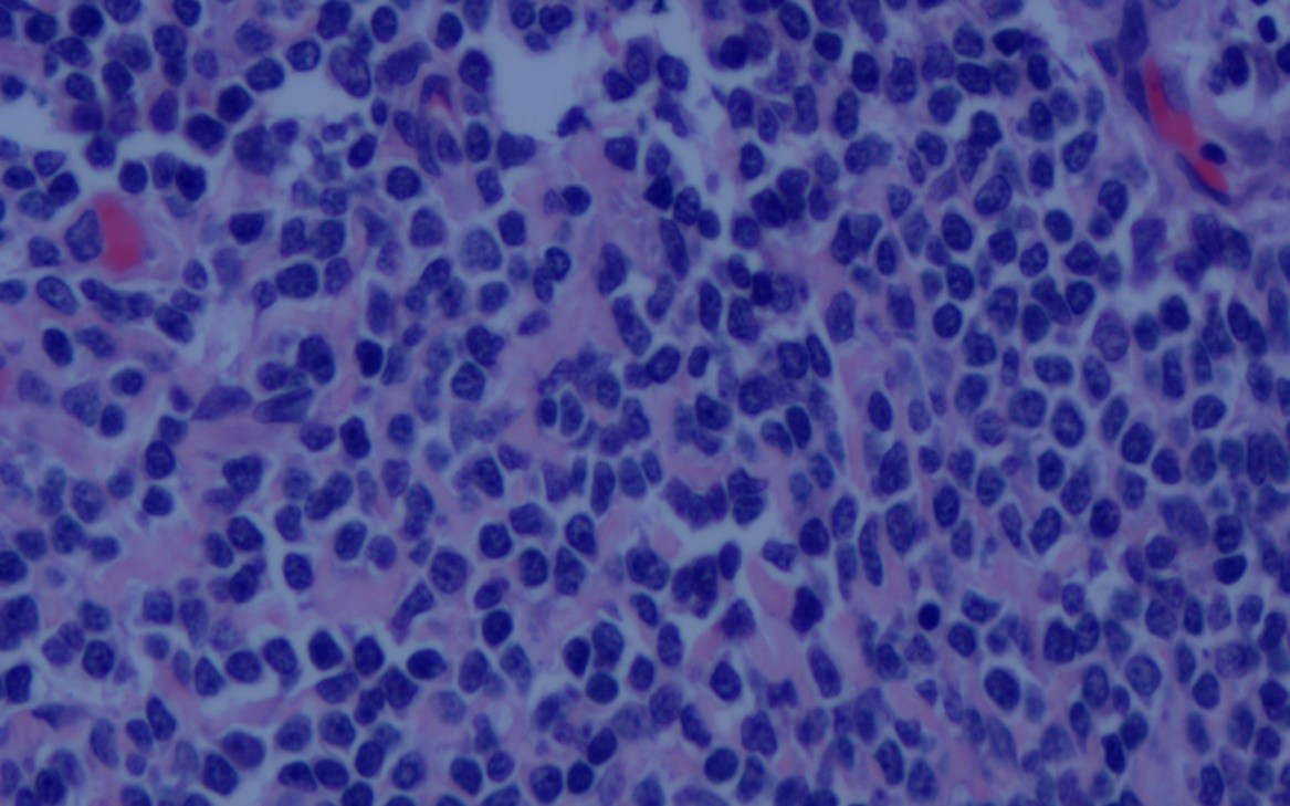 Biopsy of the small intestine tissue, showing atypical lymphoid cells mixed with inflammatory cells (H and E, ×100)