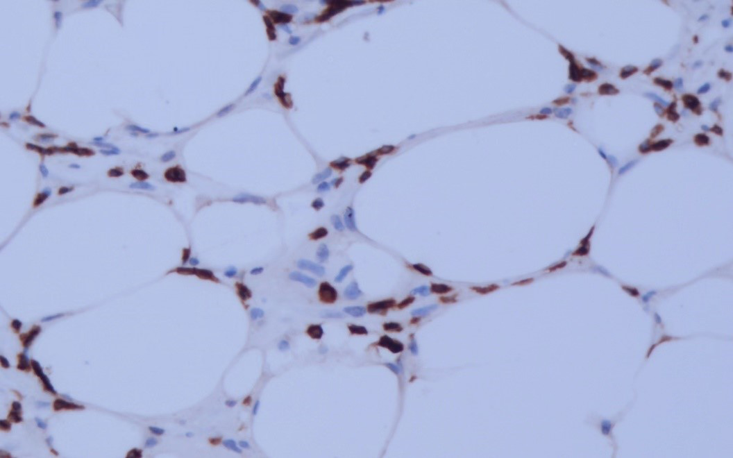 Atypical lymphoid cells partial positive for CD3 in the biopsy (CD3, ×200)