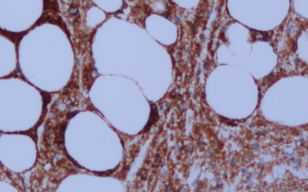 Atypical lymphoid cells partial positive for CD56 in the biopsy (CD56, ×200)