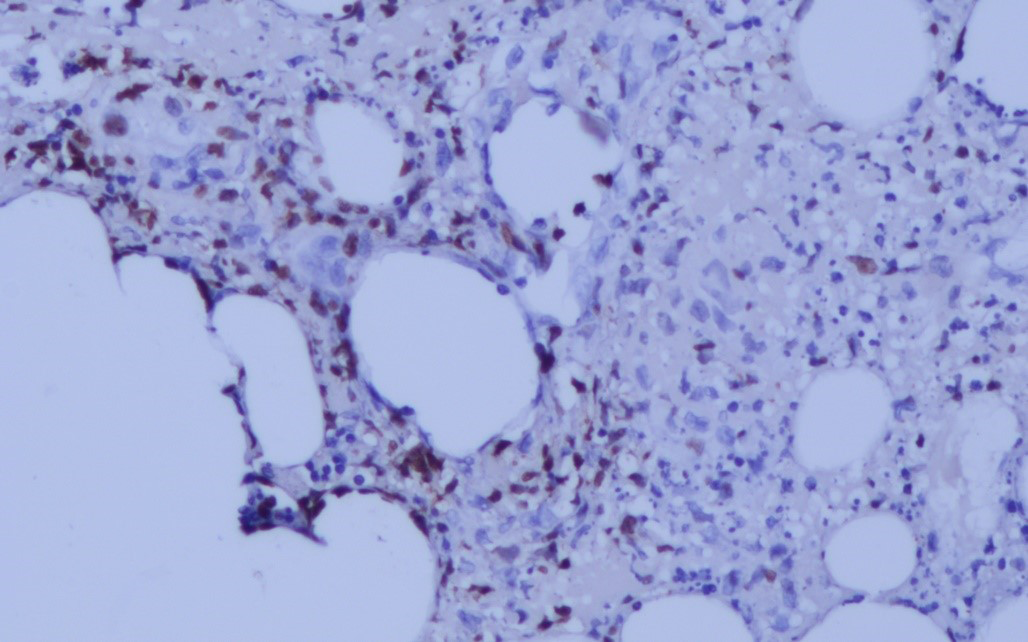 Atypical lymphoid cells partial positive for Epstein-Barr encoding region (EBER) in the biopsy (EBER, ×200)