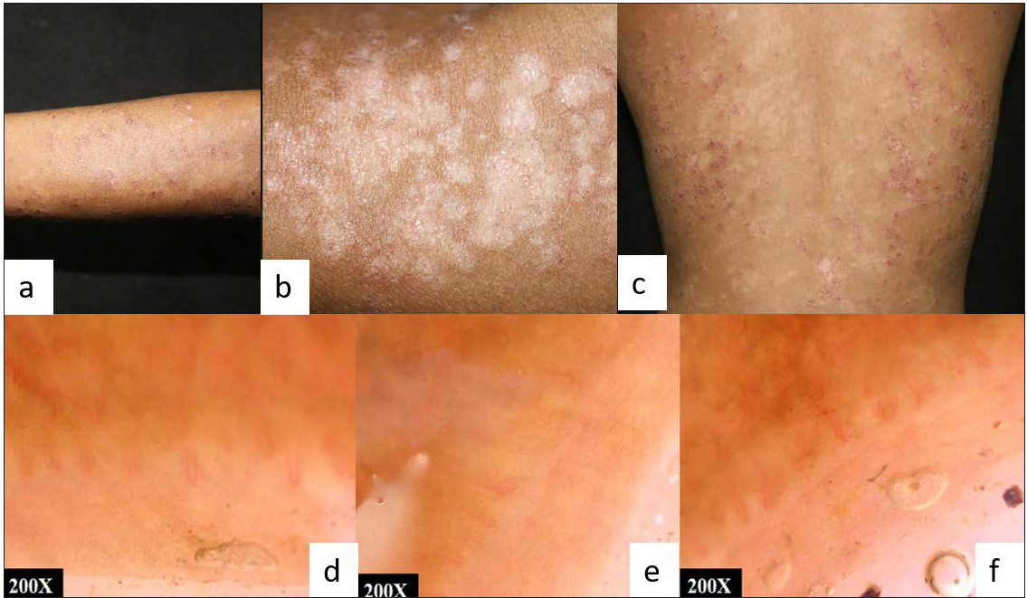 (a,b,c) SLE with papulosquamous SCLE like lesions at baseline; (d,e,f) NFC showing few dilated capillaries and reduced capillary density in non-specific pattern