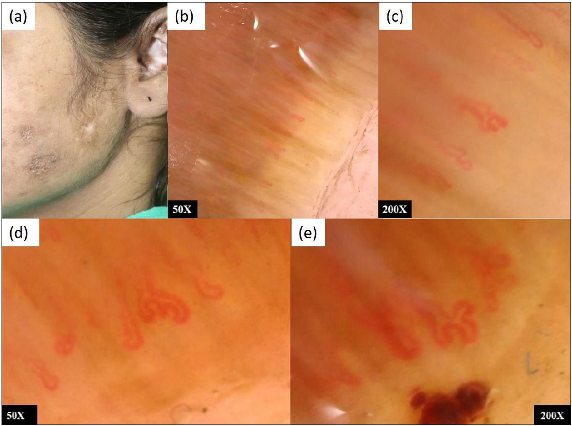 (a) SLE with discoid lupus erythematosus (DLE); (b,c) NFC showing elongated, dilated, tortuous capillaries, suggestive of SLE pattern. (d,e) Increased dilatation and tortuosity of capillaries after 6 months with the progression of the disease