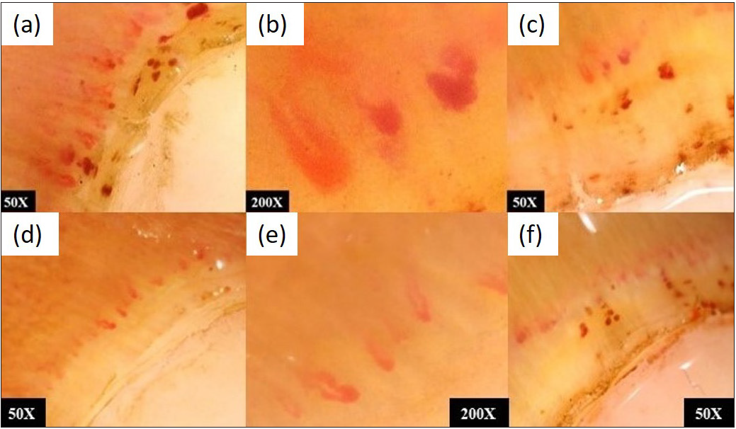 (a,b,c) A patient of diffuse cutaneous systemic sclerosis-NFC showing active pattern with capillary haemorrhages and giant capillaries. (d,e,f) Reduced number of giant and dilated capillaries, fewer microhemorrhages following treatment with methotrexate