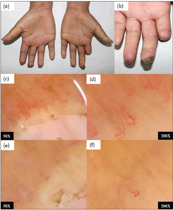 (a,b) Diffuse systemic sclerosis showing sclerodactyly, resorption of phalanges, Ingram’s sign, mat-like telangiectasias on face; (c,d) NFC showing few dilated tortuous capillaries and multiple avascular areas suggestive of late SS pattern. (e,f) NFC showing larger avascular areas and fewer dilated capillaries showing further deterioration without change in pattern