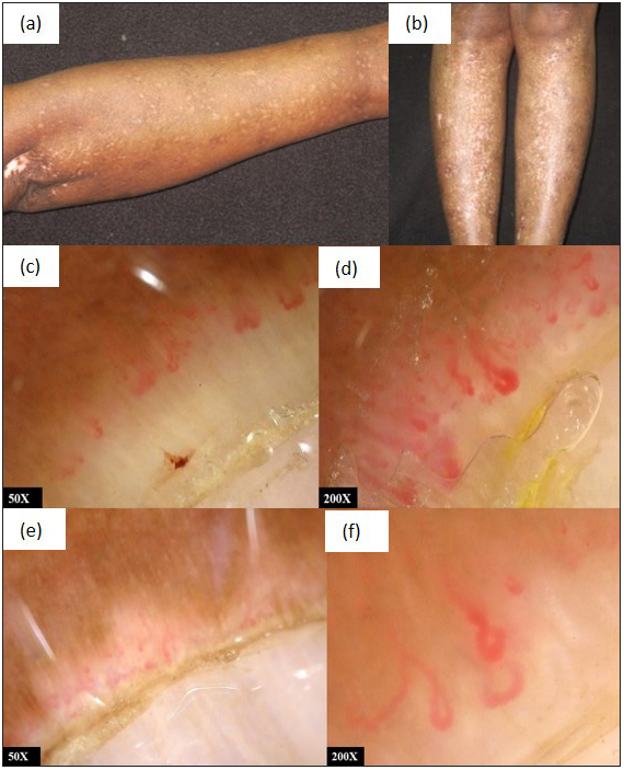 (a,b) Diffuse systemic sclerosis with salt and pepper pigmentation; (c,d) NFC at baseline showing dilated capillaries and haemorrhage suggestive of active SS pattern; (e,f) NFC of the same patient at third follow-up showing fewer dilated capillaries and large avascular areas suggestive of late SS pattern