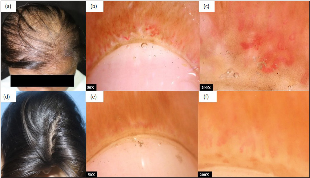(a) SLE with diffuse alopecia, (b,c) NFC showing dilated tortuous vessels and avascular areas suggestive of SLE pattern at baseline; (d) Clinical improvement at 1 year follow-up, (e,f) NFC showing reduction in abnormal capillaries and avascular areas