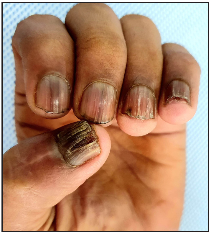Nail lichen planus presenting as melanonychia, onychorrhexis, and longitudinal ridging involving left fingernails.