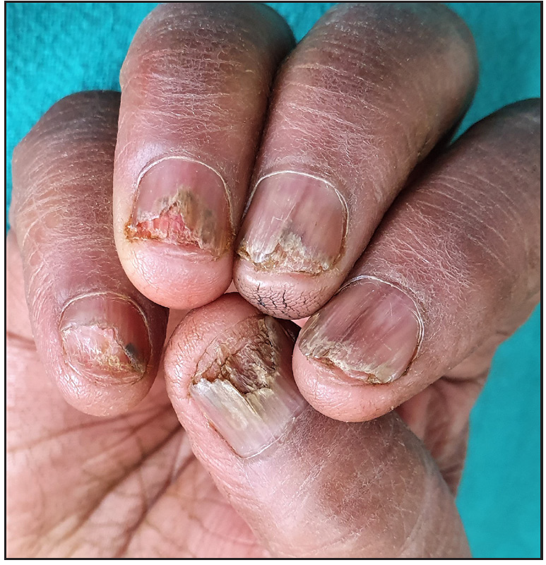 Nail lichen planus presenting as onycholysis, subungual hyperkeratosis, splinter hemorrhage, and nail bed erythema with longitudinal ridging and distal splitting involving right fingernails.