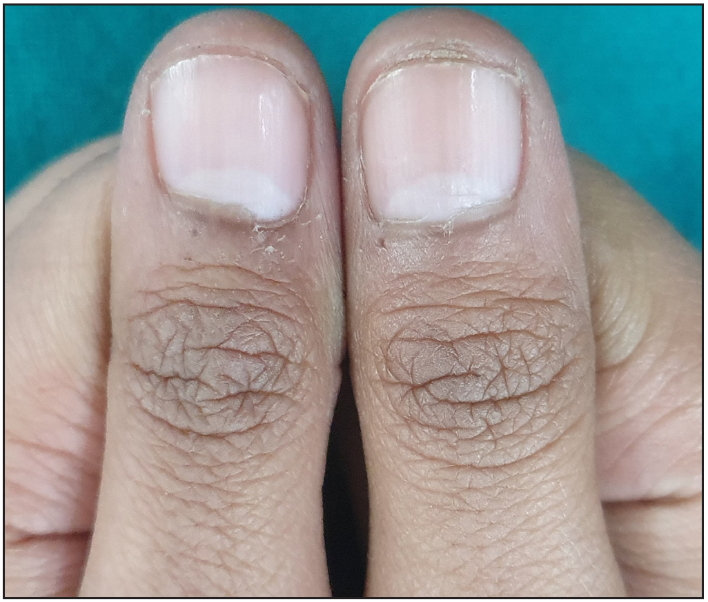 Nail lichen planus of the thumbnails 6 months after treatment with intramuscular triamcinolone acetonide.