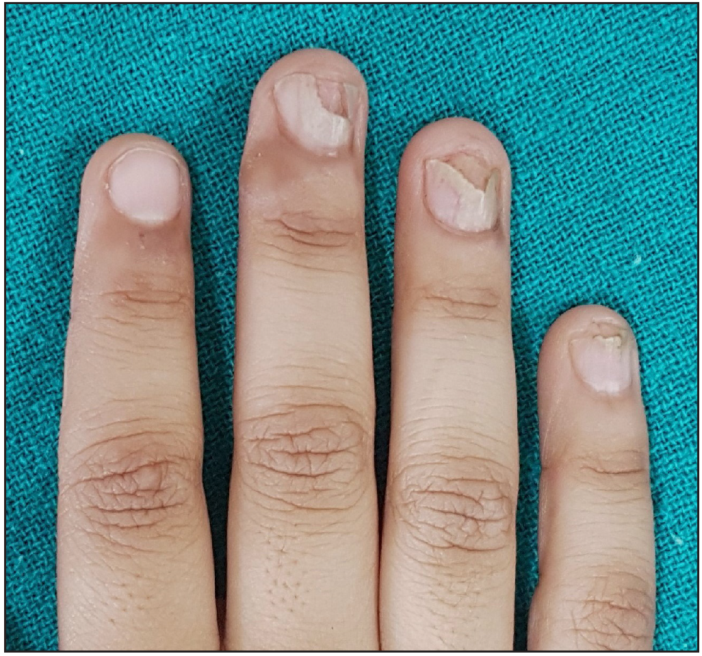 Nail lichen planus of the fingernails before treatment.