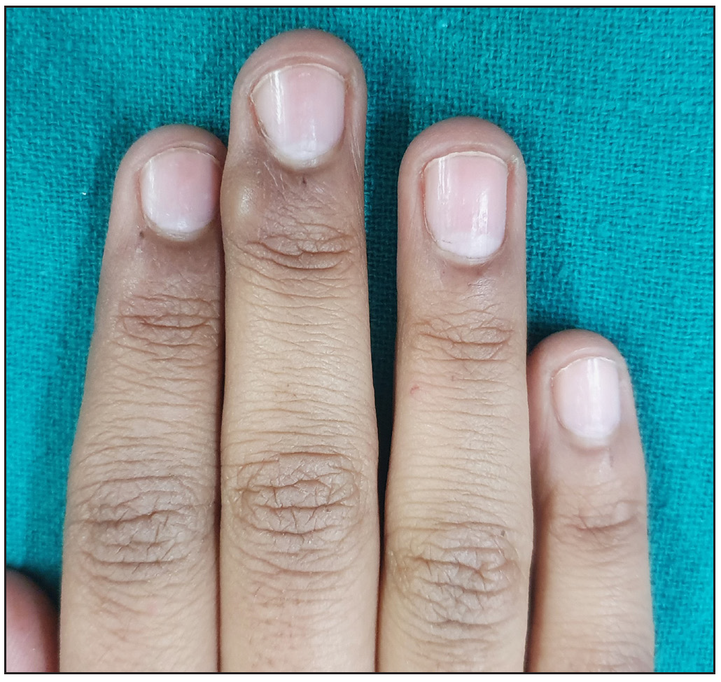 Nail lichen planus of the fingernails 6 months after treatment.