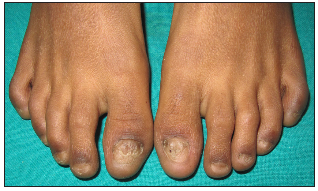 Anonychia associated with nail bed retraction involving all toenails.