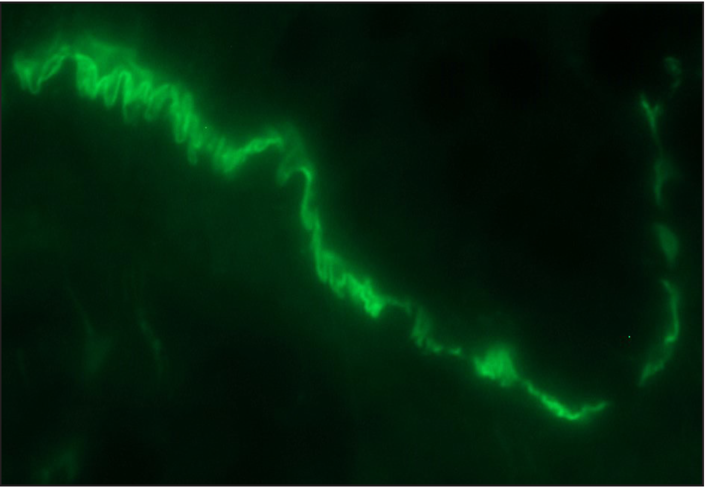 Direct immunofluorescence (DIF) high power examination in a case of bullous pemphigoid showing “n” serrated pattern (fluorescein isothiocyanate, ×1000 under oil immersion)