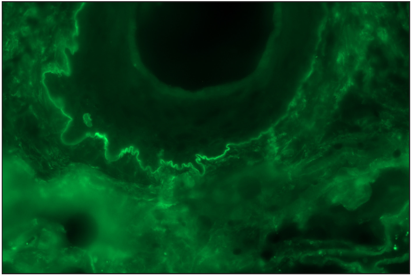 ‘n’ serration pattern along hair follicle basement membrane on DIF in bullous pemphigoid (fluorescein isothiocyanate, ×400)
