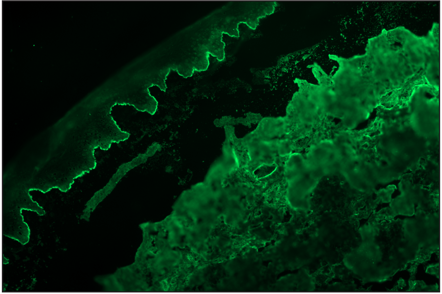 Salt split skin (in house) indirect immunofluorescence of bullous pemphigoid shows roof binding of IgG (fluorescein isothiocyanate, ×200)