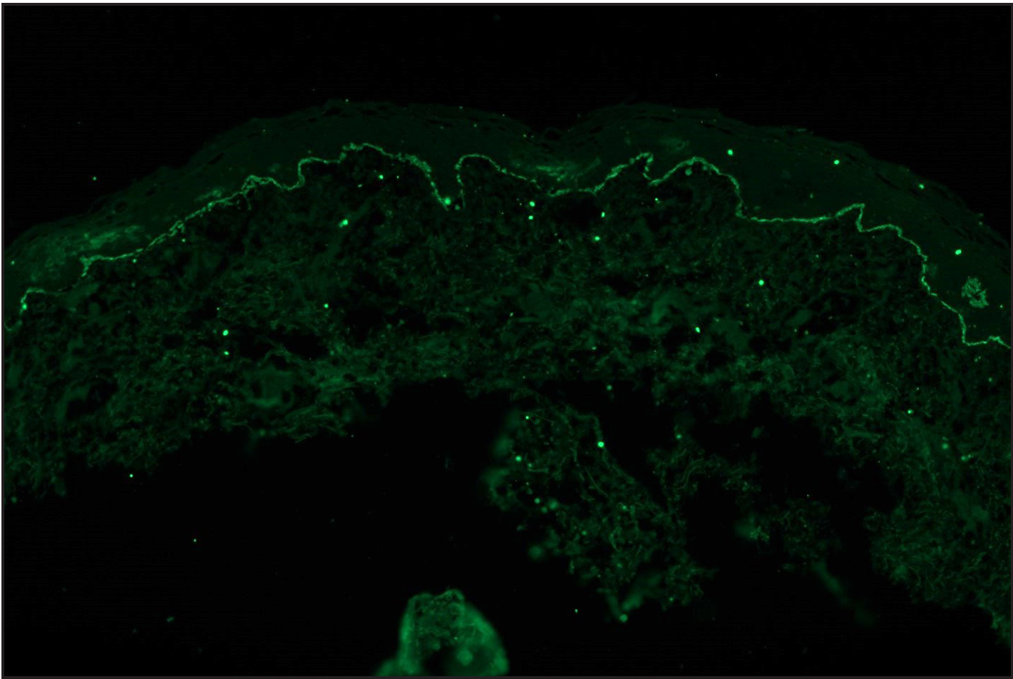 Direct immunofluorescence (DIF) in a case of epidermolysis bullosa acquisita (EBA) showing linear IgG deposition along dermoepidermal junction (fluorescein isothiocyanate, ×100)