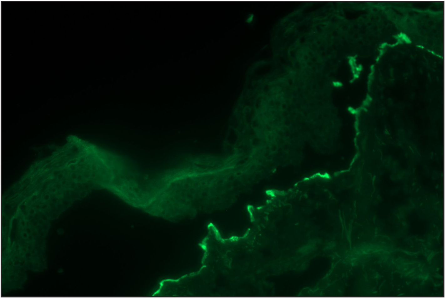 Salt split skin (in house) indirect immunofluorescence of EBA case shows floor binding of IgG (fluorescein isothiocyanate, ×200)