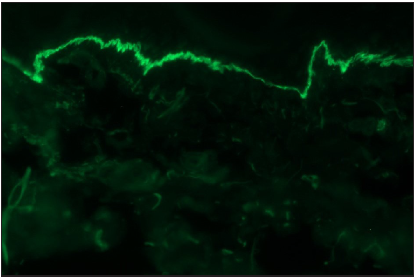Direct immunofluorescence (DIF) in a case of suspected anti p-200 pemphigoid showing linear IgG deposition along dermoepidermal junction (fluorescein isothiocyanate, ×200)