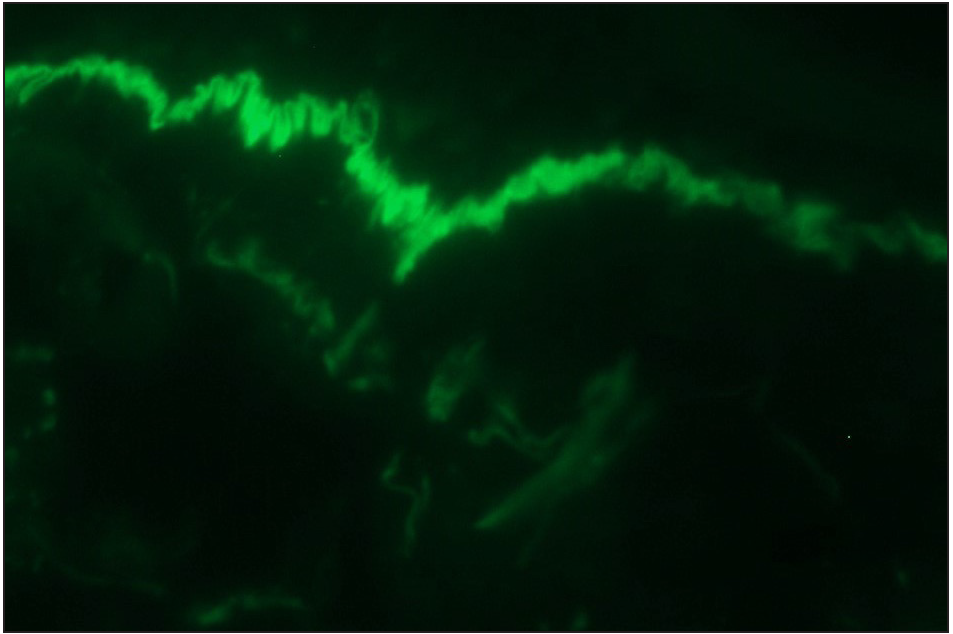 Direct immunofluorescence (DIF) high power examination of the same case in Figure 3a showing “n” serrated pattern (fluorescein isothiocyanate, ×1000 under oil immersion)