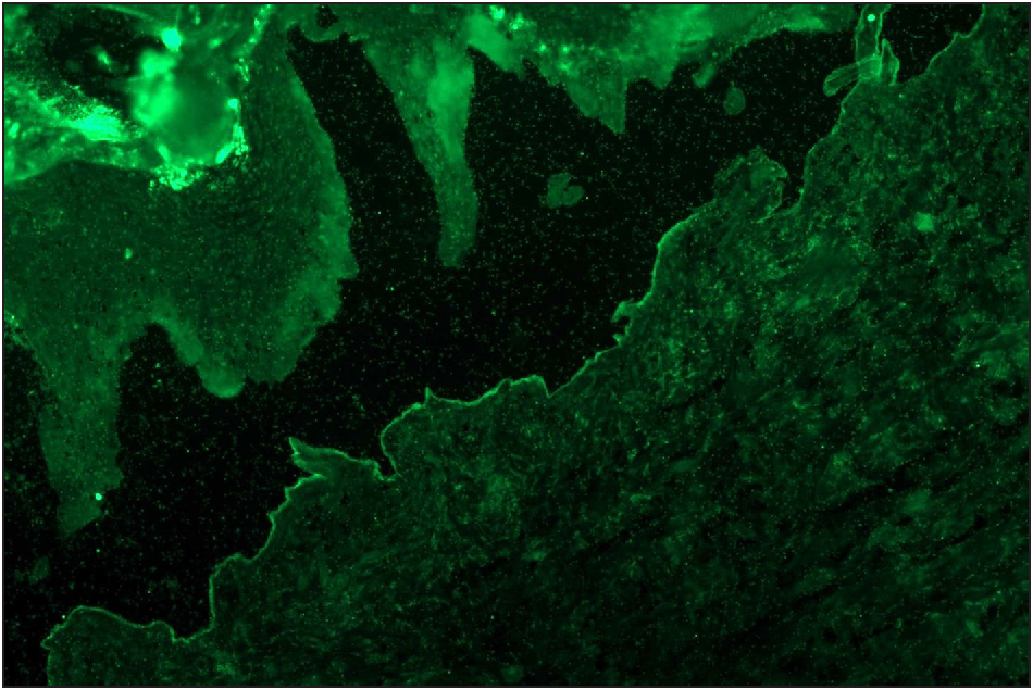 Salt split skin (in house) indirect immunofluorescence of the suspected anti-p200 pemphigoid shows floor binding of IgG (fluorescein isothiocyanate, ×200)